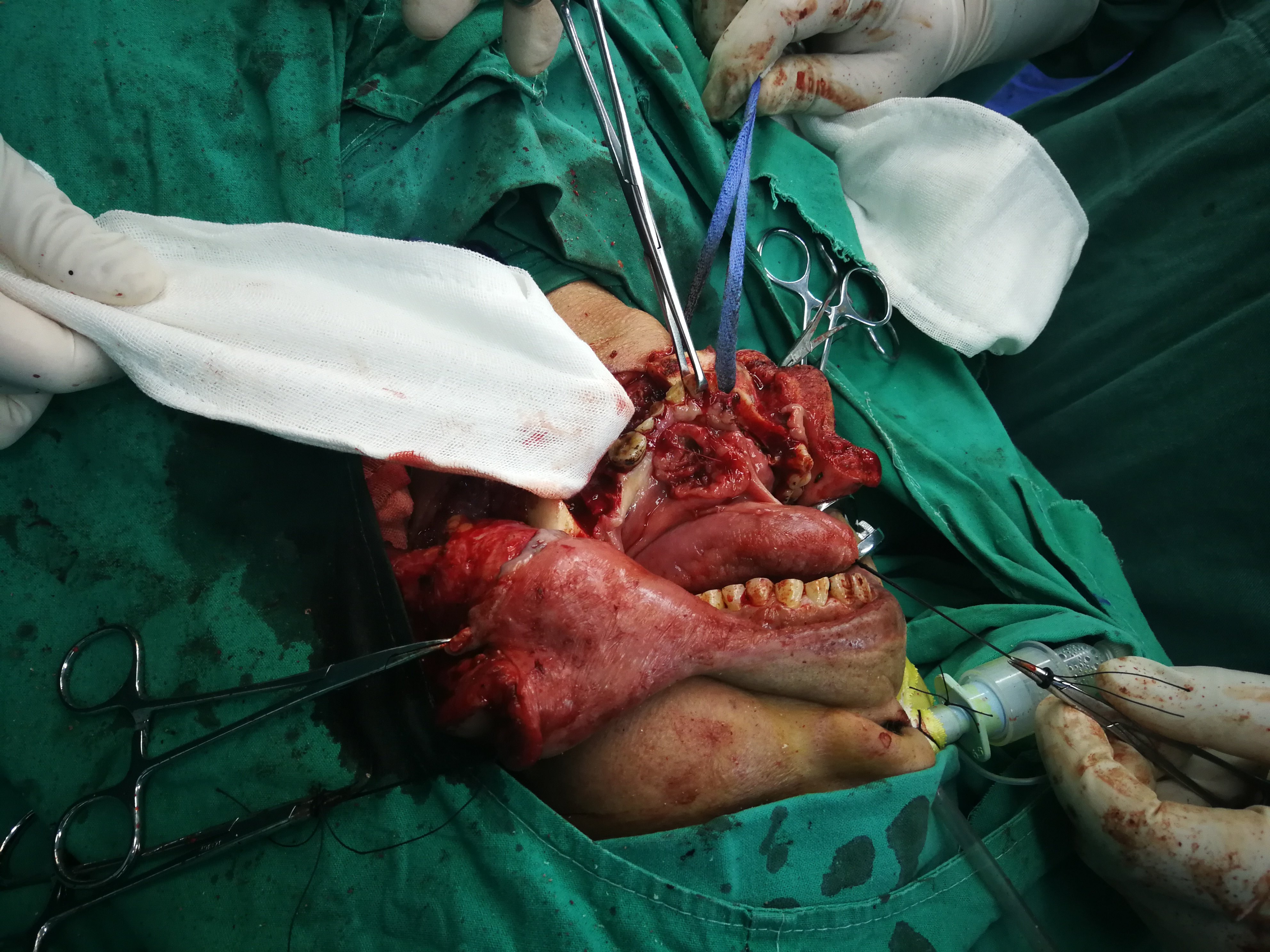 林丹发文疑似回应退役_当事医生回应莲子壳诊断为疑似肿瘤_警方回应疑似未成年女孩嫁中年男子