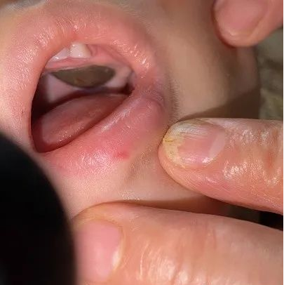 疑似郑爽小号发文回应你给我等着_疑似甲类传染病 明确诊断前如何管理_当事医生回应莲子壳诊断为疑似肿瘤