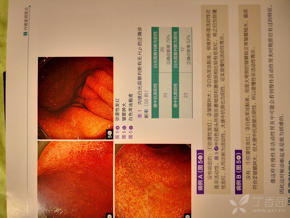 盐酸消旋山莨菪片 幽门螺杆_1家4人查出幽门螺杆菌 最小的6岁_幽门螺杆螺杆菌 抗体
