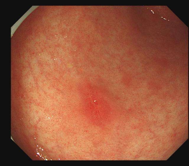 盐酸消旋山莨菪片 幽门螺杆_幽门螺杆螺杆菌 抗体_1家4人查出幽门螺杆菌 最小的6岁