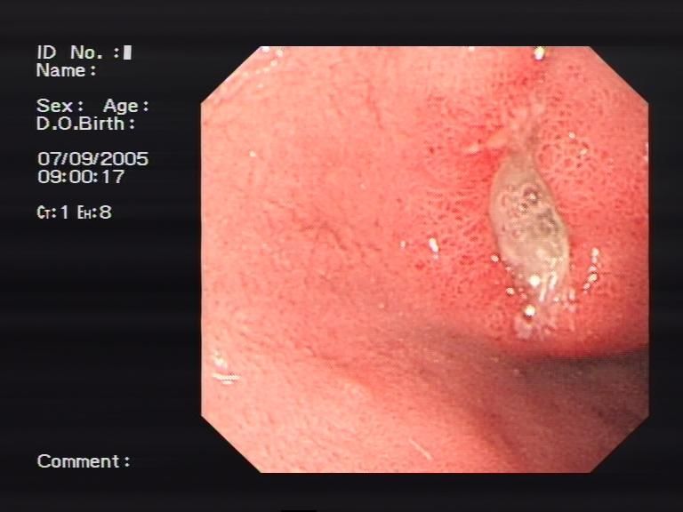盐酸消旋山莨菪片 幽门螺杆_1家4人查出幽门螺杆菌 最小的6岁_幽门螺杆螺杆菌 抗体
