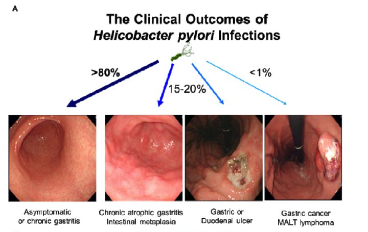 幽门螺杆杆菌_1家4人查出幽门螺杆菌 最小的6岁_盐酸消旋山莨菪片 幽门螺杆