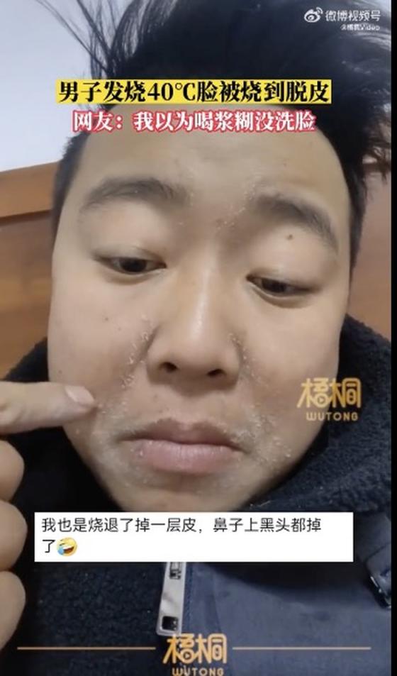 大连一孕妇感染新冠后诞下男婴_感染新冠后牙齿变黑_伊朗第一副总统确诊感染新冠病毒
