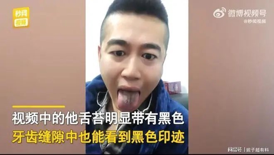 法国文化部长确诊感染新冠肺炎_戴烤瓷冠套后感觉牙齿软软的_感染新冠后牙齿变黑