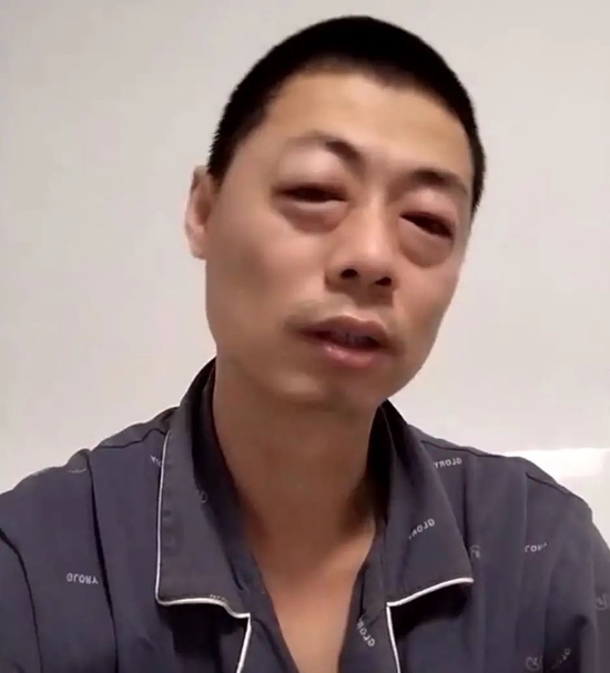 法国文化部长确诊感染新冠肺炎_感染新冠后牙齿变黑_戴烤瓷冠套后感觉牙齿软软的