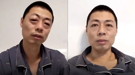 戴烤瓷冠套后感觉牙齿软软的_感染新冠后牙齿变黑_法国文化部长确诊感染新冠肺炎