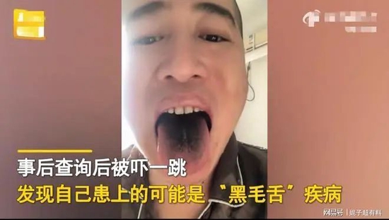 感染新冠后牙齿变黑_法国文化部长确诊感染新冠肺炎_戴烤瓷冠套后感觉牙齿软软的