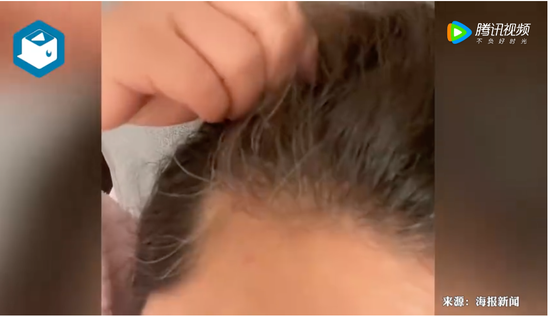 戴烤瓷冠套后感觉牙齿软软的_法国文化部长确诊感染新冠肺炎_感染新冠后牙齿变黑