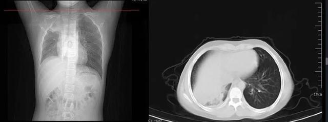 阳康后咳嗽怎么办_滨阳燃化办公室电话_社保是先办减员后办失业吗