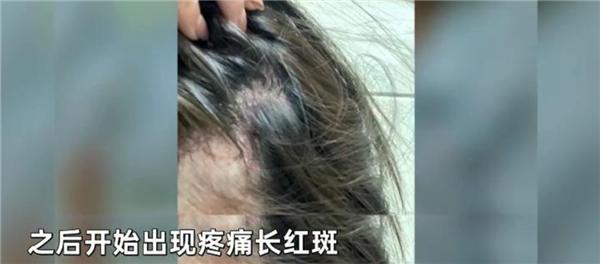注射玻尿酸后多久打美白针_玻尿酸注射泪沟血管明显_注射玻尿酸打进血管